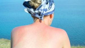 Hausmittel zur Sonnenbrand Behandlung