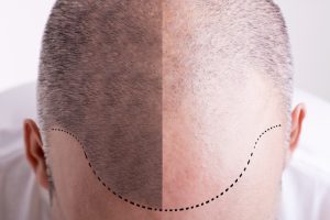 Haartransplantation