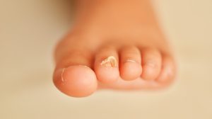 Nagelpilz Hausmittel