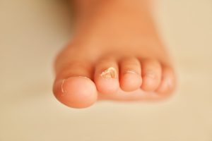 Nagelpilz Hausmittel