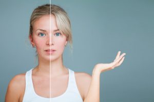 Rosacea behandeln