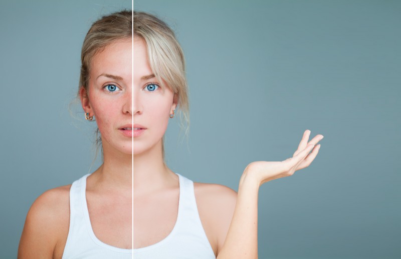 Rosacea behandeln