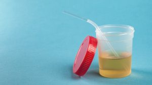 Eigenurintherapie durchführen